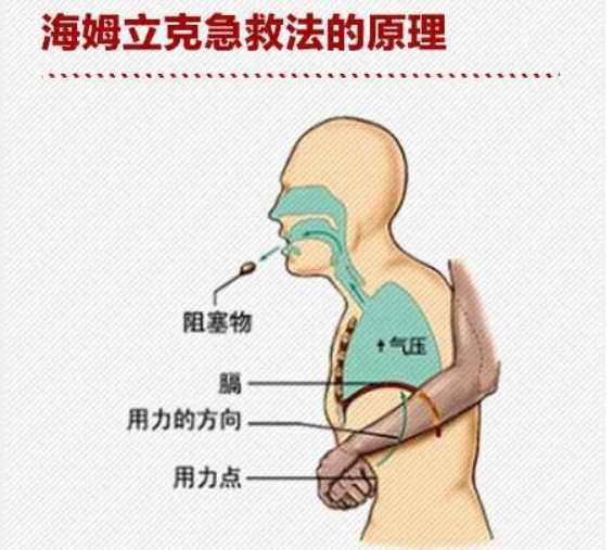 学会海姆立克急救法  关键时刻能挽救一条生命